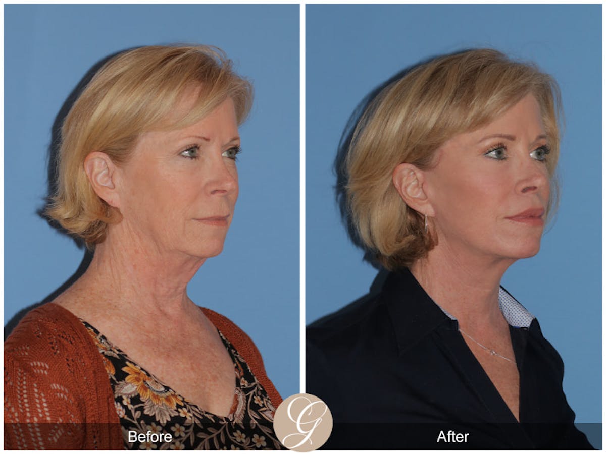 Preservation Facelift Before & After Gallery - Patient 927687 - Image 2