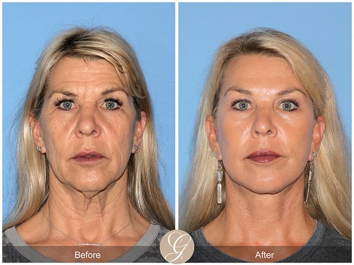 Preservation Facelift Before & After Gallery - Patient 150273 - Image 1