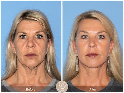 Deep Plane Facelift Before & After Gallery - Patient 932447 - Image 1
