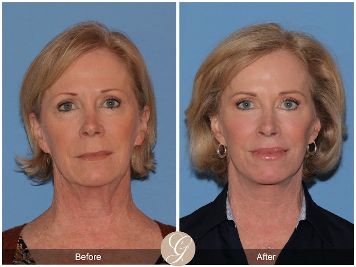 Preservation Facelift Before & After Gallery - Patient 927687 - Image 1