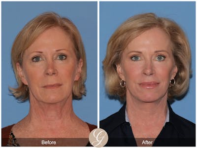 Deep Plane Facelift Before & After Gallery - Patient 770438 - Image 1