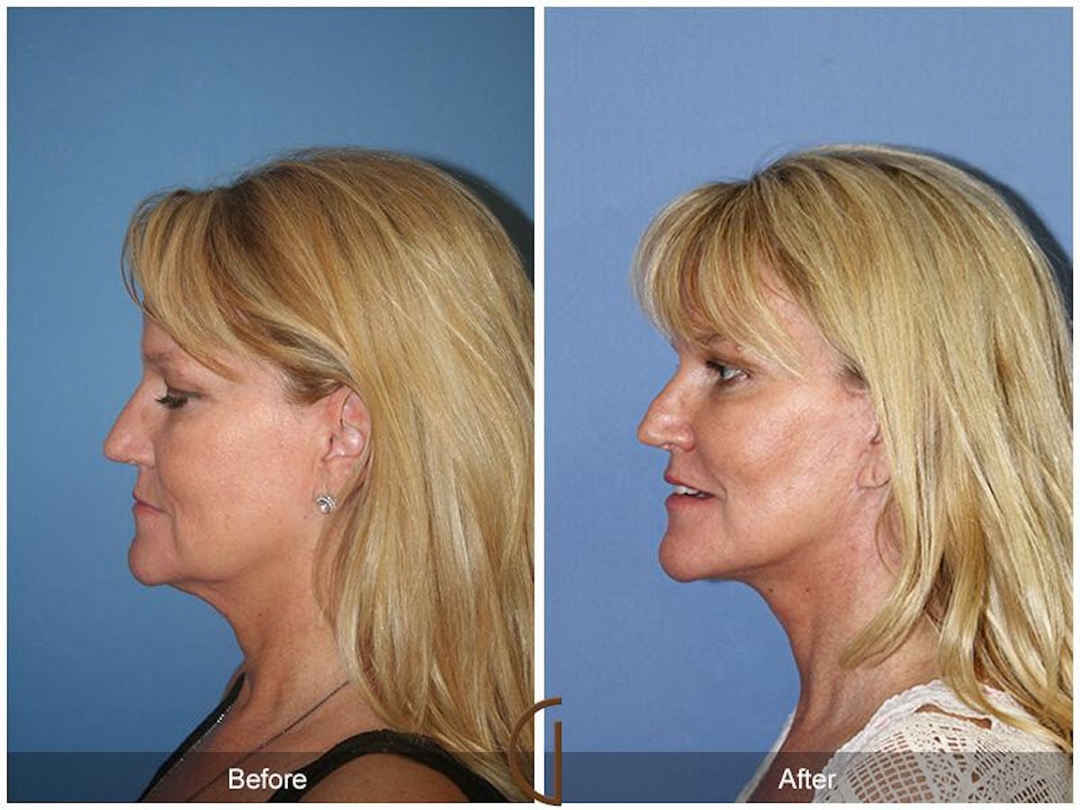 Facelift 50s Before & After Gallery - Patient 426078 - Image 1