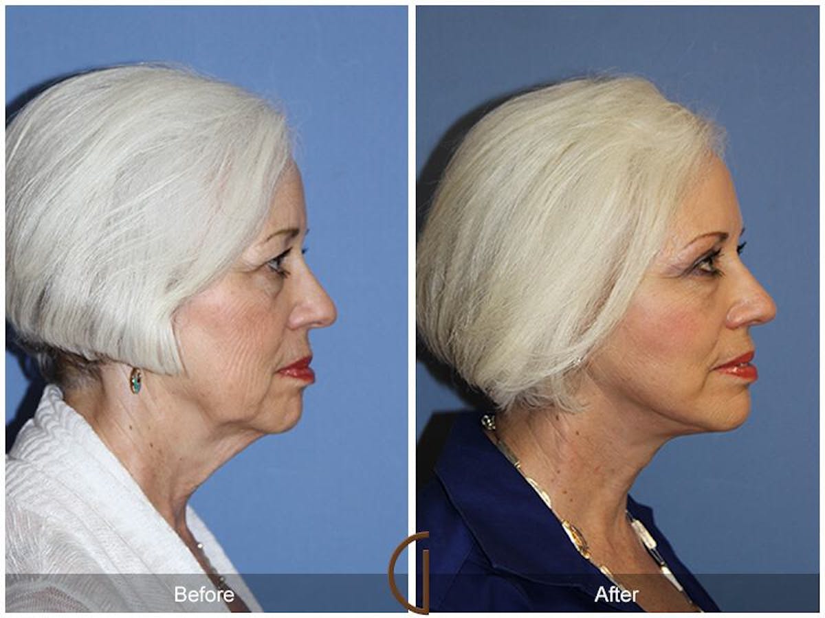 Facelift 70s Before & After Gallery - Patient 269629 - Image 3
