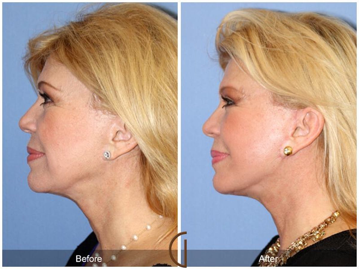 Facelift 60s Before & After Gallery - Patient 327741 - Image 1