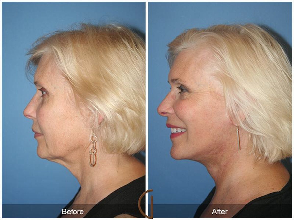 Facelift 60s Before & After Gallery - Patient 124394 - Image 1