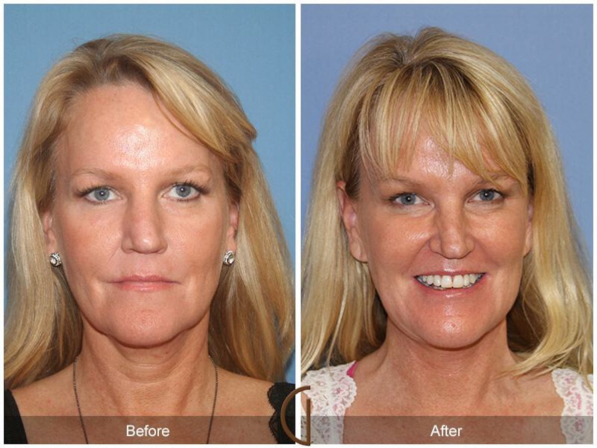 Facelift 50s Before & After Gallery - Patient 426078 - Image 2