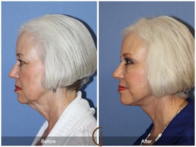 Neck Lift Before & After Gallery - Patient 373892 - Image 1