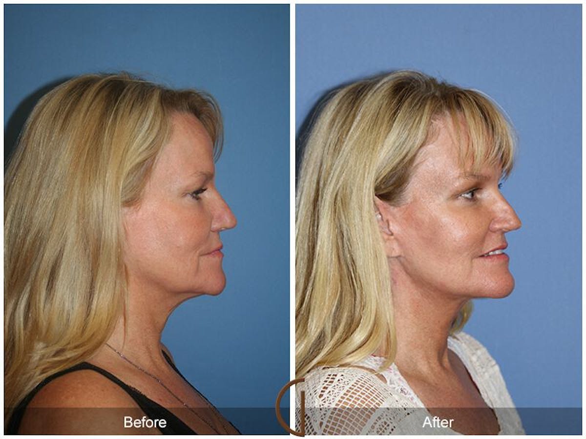 Facelift 50s Before & After Gallery - Patient 426078 - Image 3
