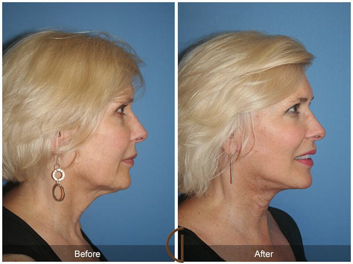 Facelift 60s Before & After Gallery - Patient 124394 - Image 3