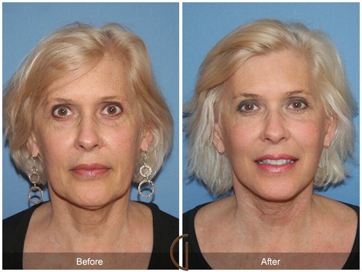 Facelift 60s Before & After Gallery - Patient 124394 - Image 2