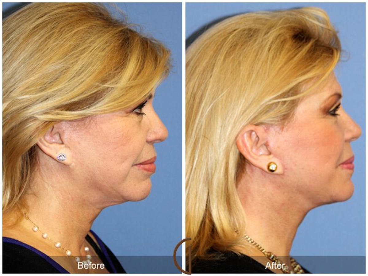 Facelift 60s Before & After Gallery - Patient 327741 - Image 3