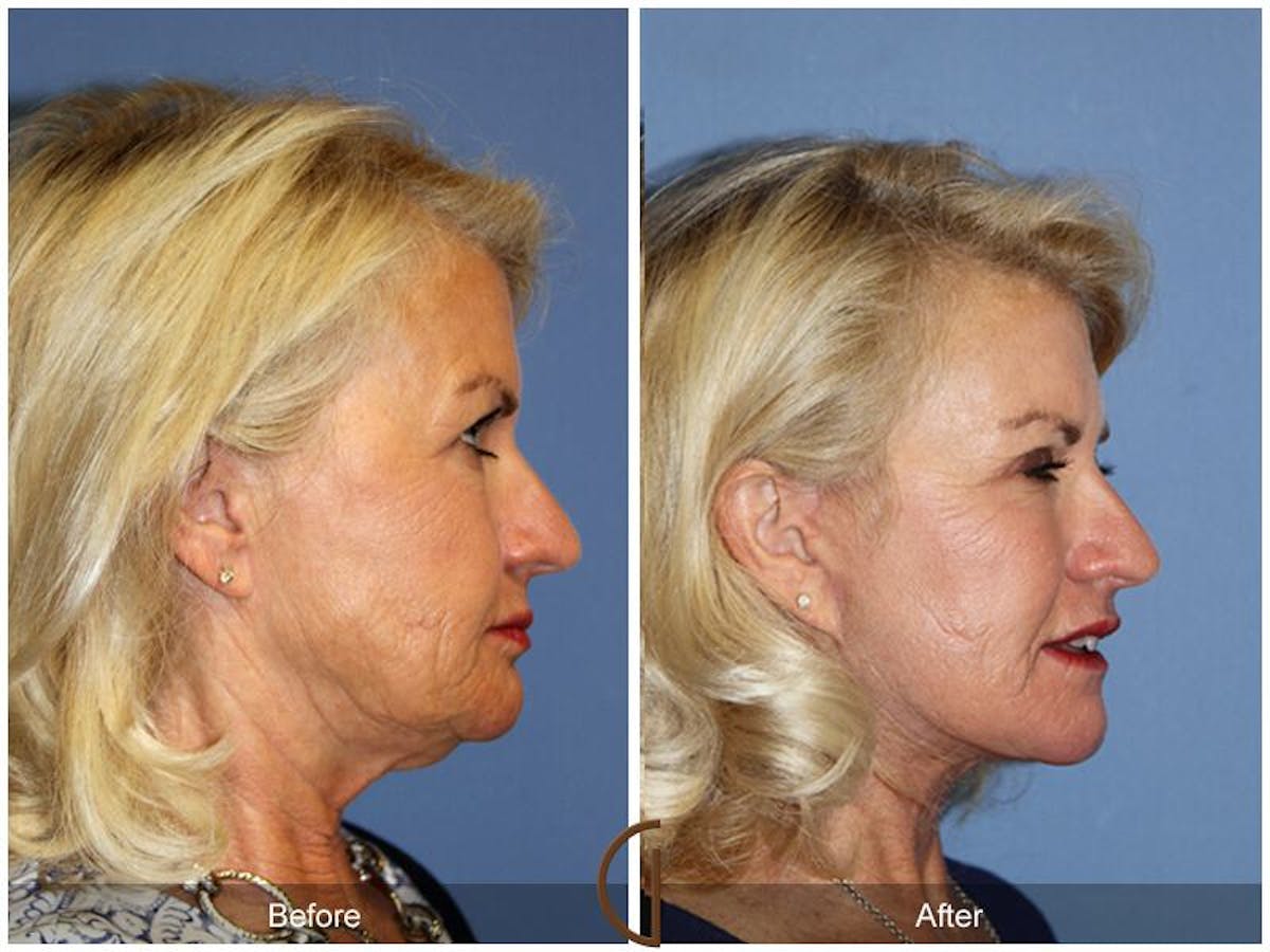 Facelift 60s Before & After Gallery - Patient 114859 - Image 3