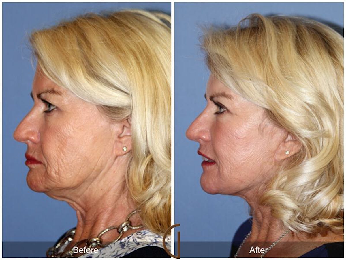 Facelift 60s Before & After Gallery - Patient 114859 - Image 1