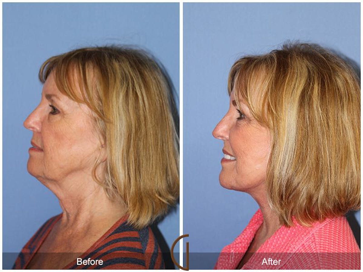 Facelift 60s Before & After Gallery - Patient 657150 - Image 1