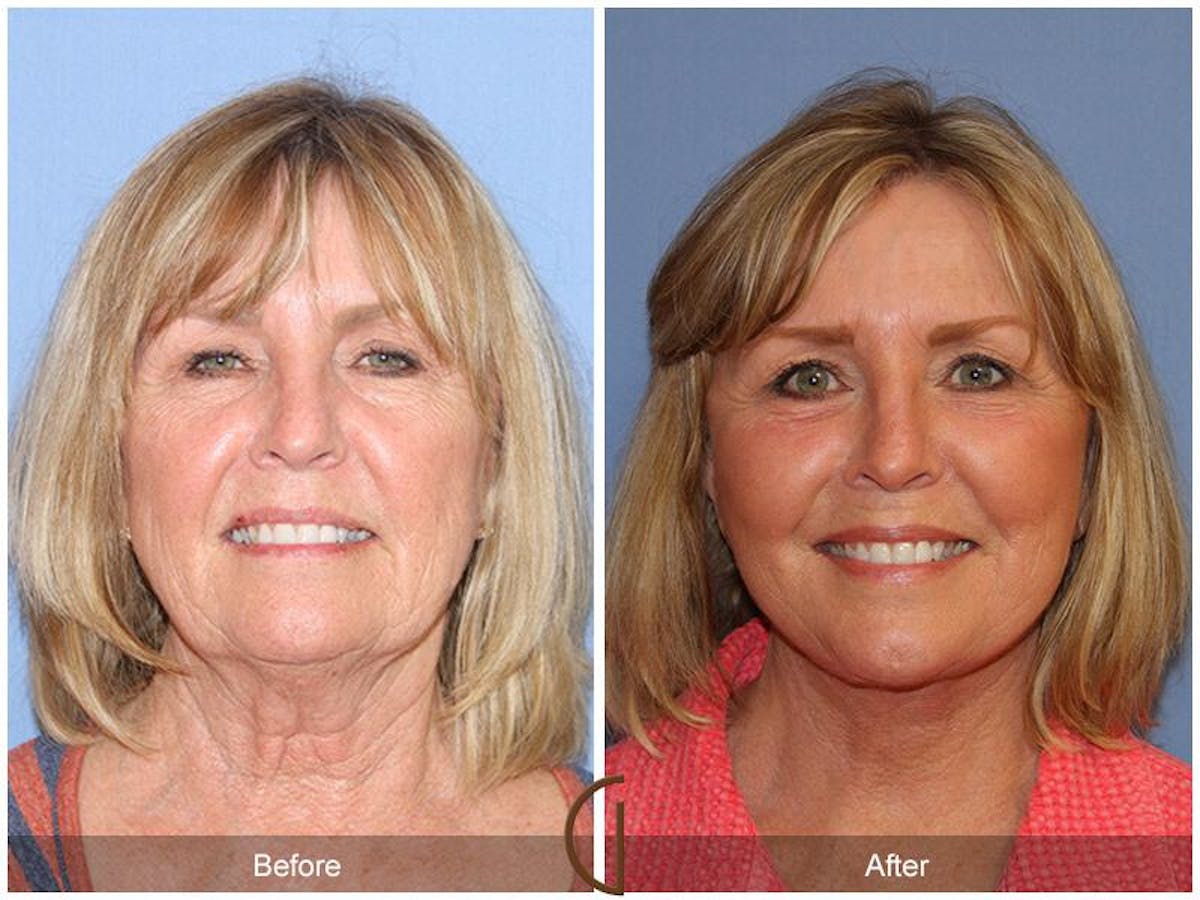 Facelift 60s Before & After Gallery - Patient 657150 - Image 2