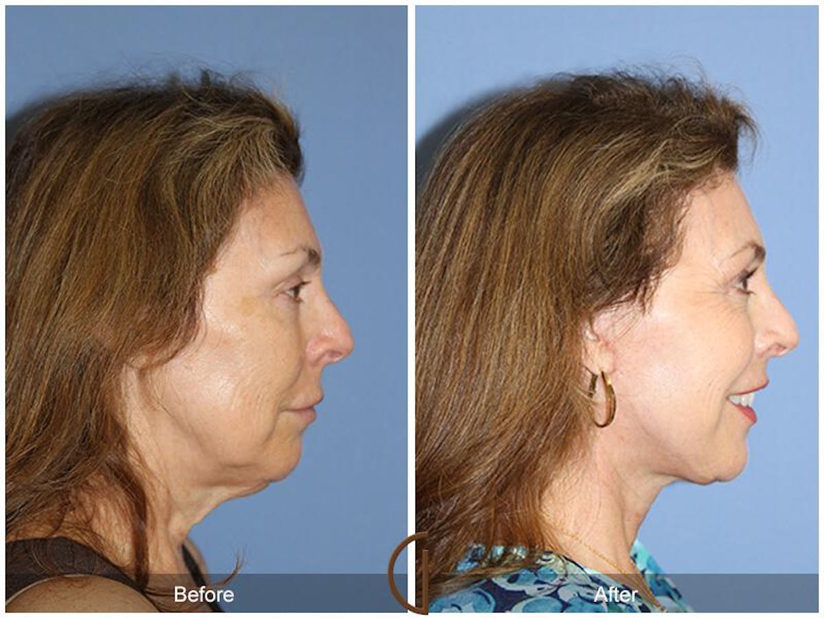 Facelift 60s Before & After Gallery - Patient 315322 - Image 3