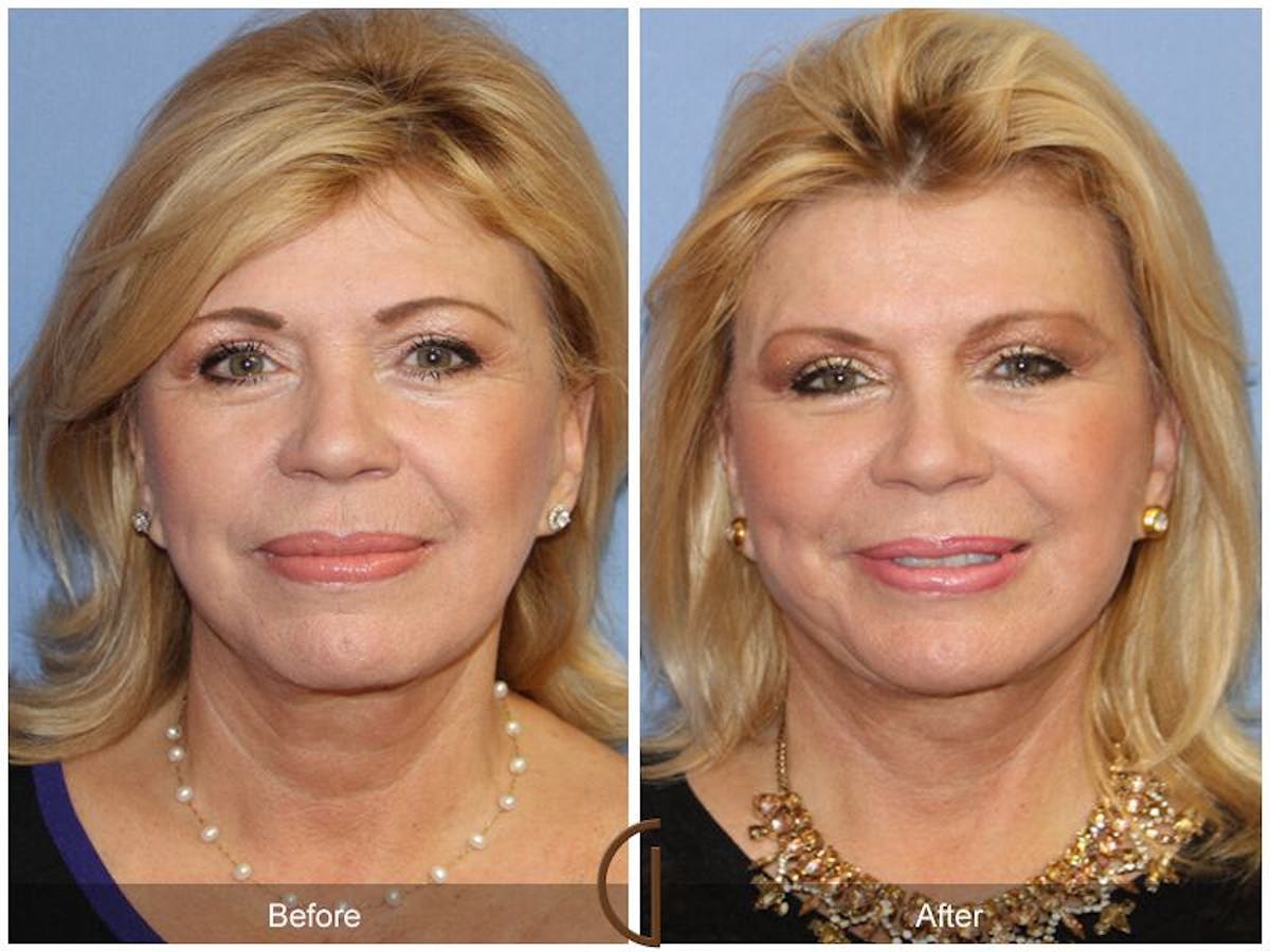 Facelift 60s Before & After Gallery - Patient 327741 - Image 2