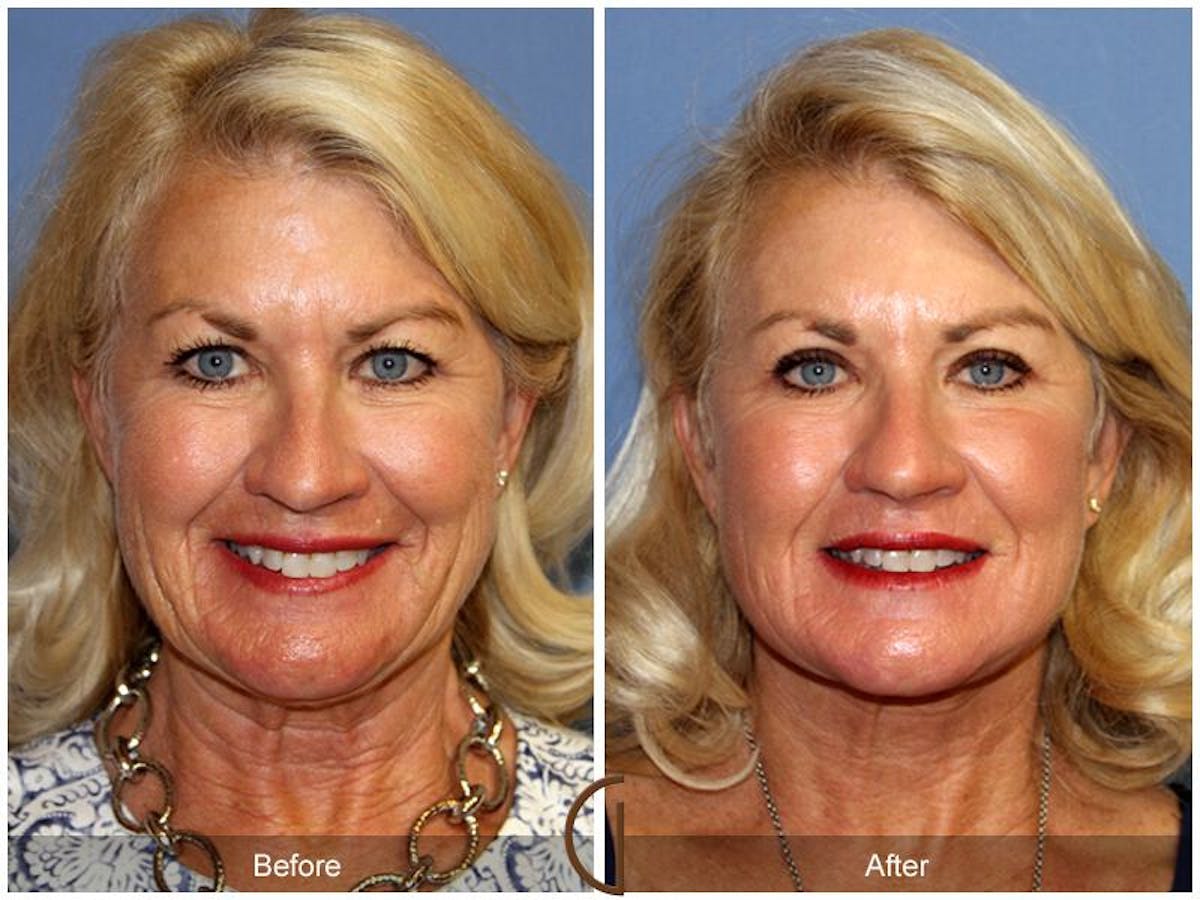 Facelift 60s Before & After Gallery - Patient 114859 - Image 2