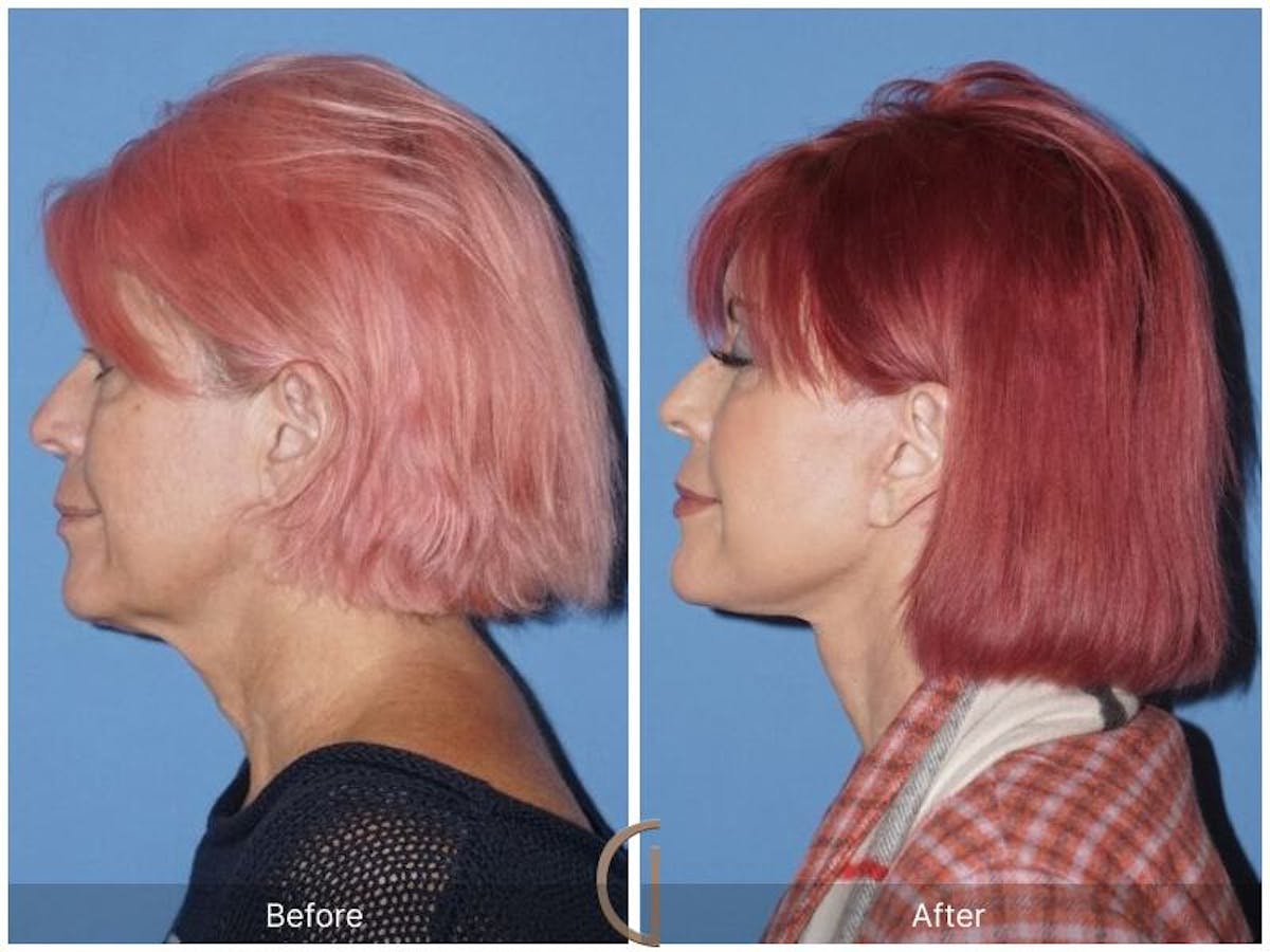 Facelift 60s Before & After Gallery - Patient 634376 - Image 1