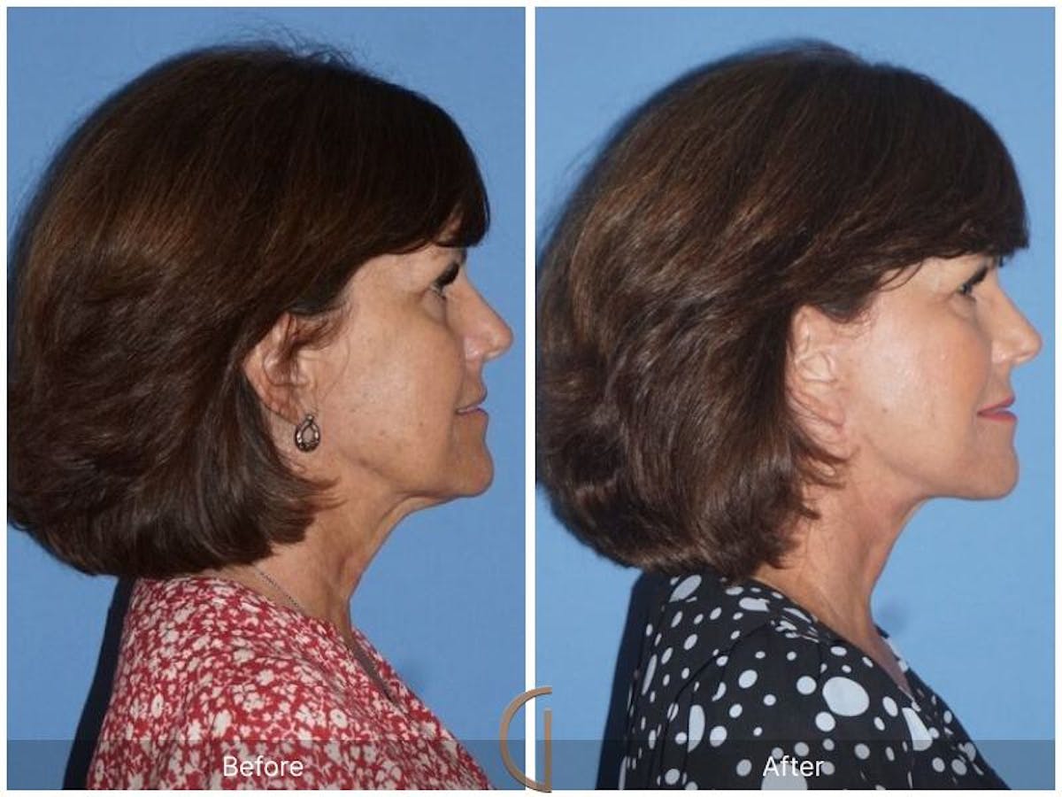 Facelift 60s Before & After Gallery - Patient 211055 - Image 3