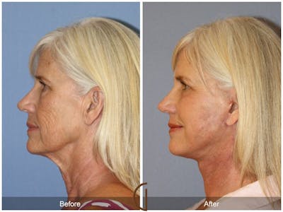 Neck Lift Before & After Gallery - Patient 986176 - Image 1