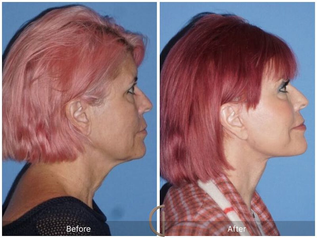 Facelift 60s Before & After Gallery - Patient 634376 - Image 3