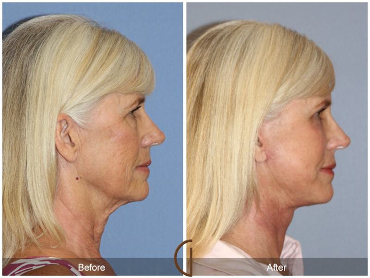 Facelift 60s Before & After Gallery - Patient 347139 - Image 3