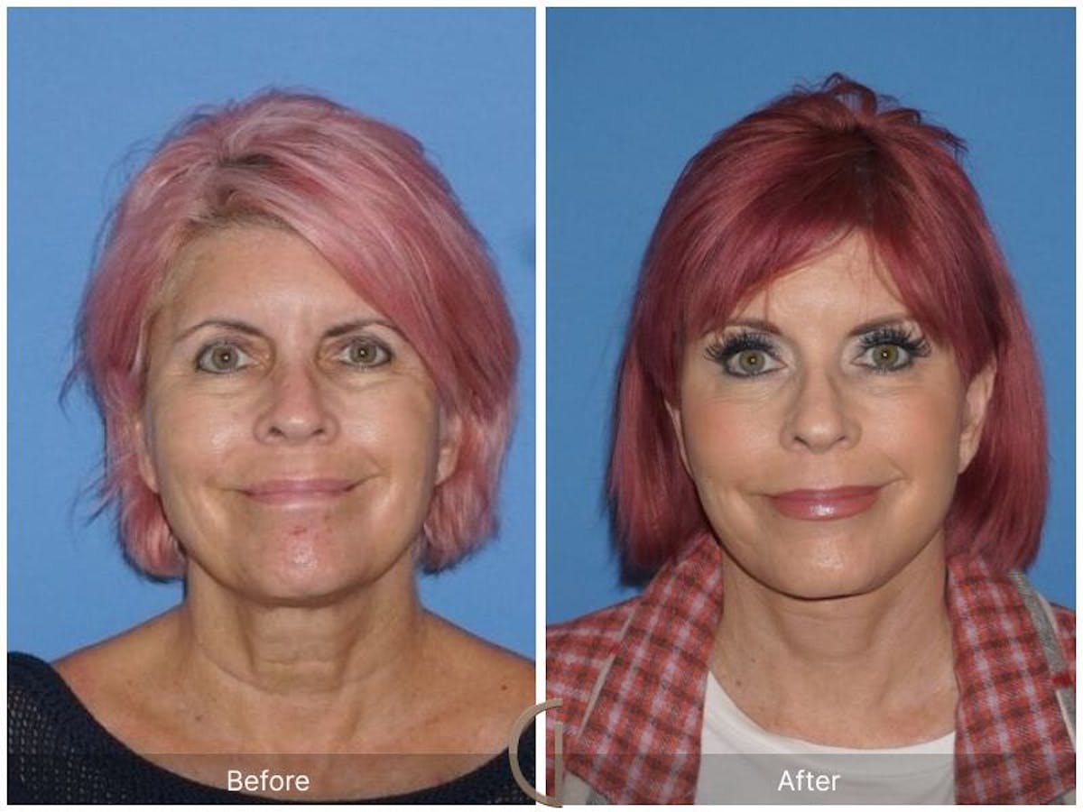 Facelift 60s Before & After Gallery - Patient 634376 - Image 2