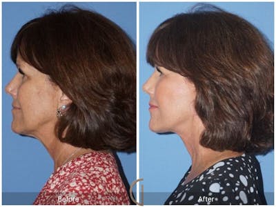 SMAS Facelift Before & After Gallery - Patient 927839 - Image 1