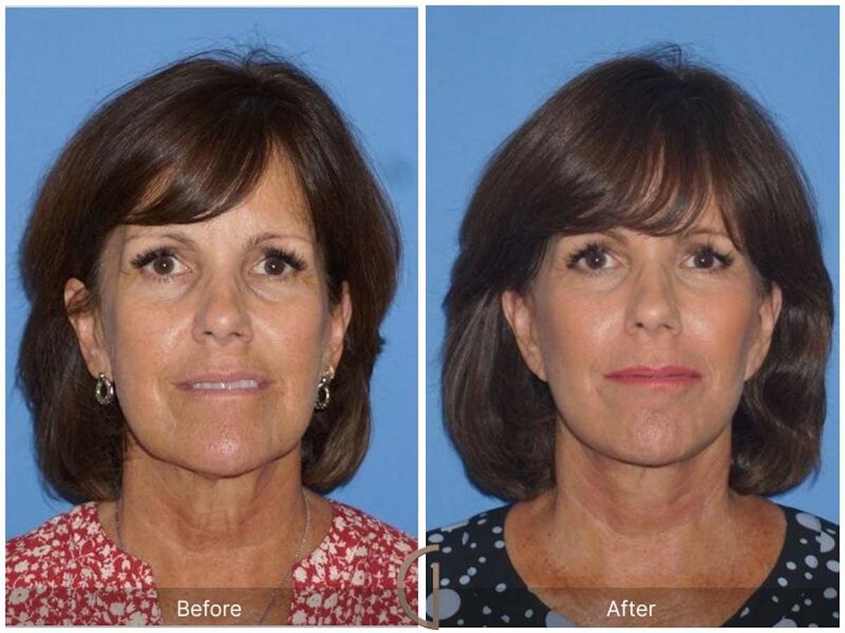 Facelift 60s Before & After Gallery - Patient 211055 - Image 2