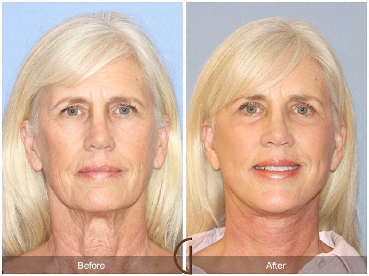 Facelift 60s Before & After Gallery - Patient 347139 - Image 2