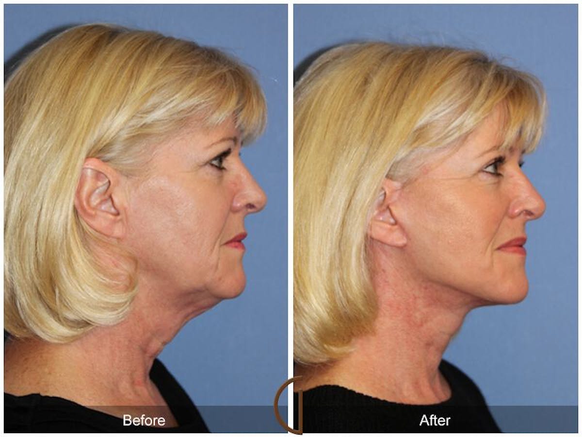 Facelift 60s Before & After Gallery - Patient 146177 - Image 3