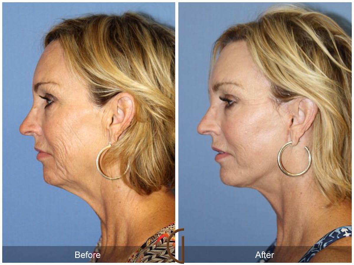 Facelift 50s Before & After Gallery - Patient 135901 - Image 1