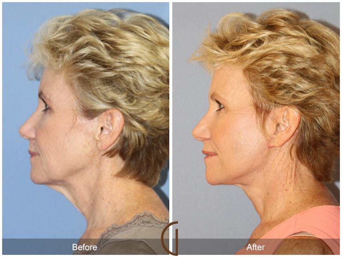 Facelift 60s Before & After Gallery - Patient 140043 - Image 1