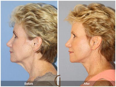 Neck Lift Before & After Gallery - Patient 127852 - Image 1