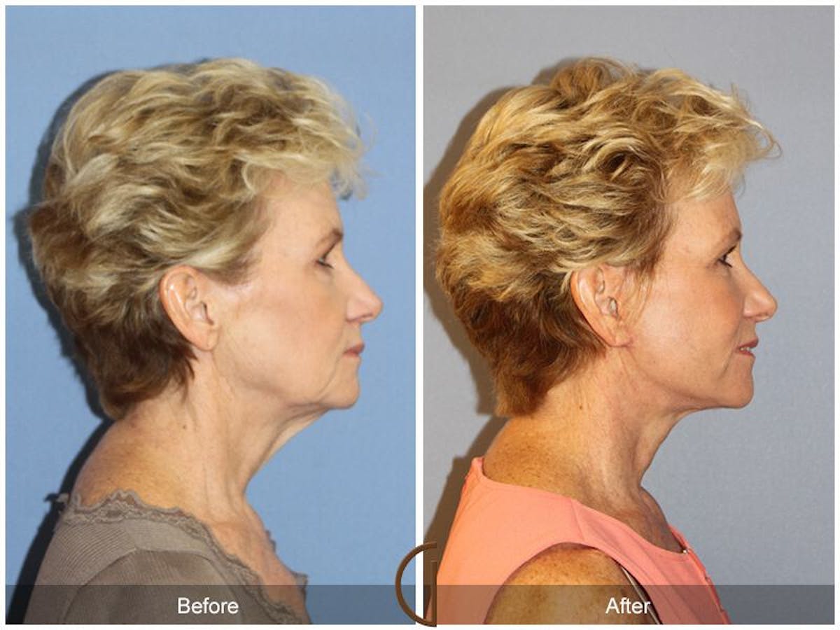 Facelift 60s Before & After Gallery - Patient 140043 - Image 3