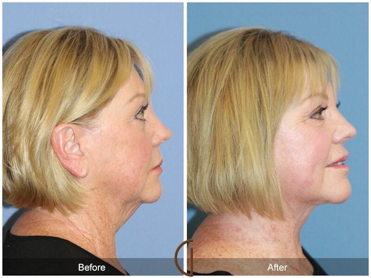 Facelift 60s Before & After Gallery - Patient 134431 - Image 3