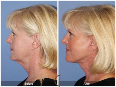 Neck Lift Before & After Gallery - Patient 285349 - Image 1