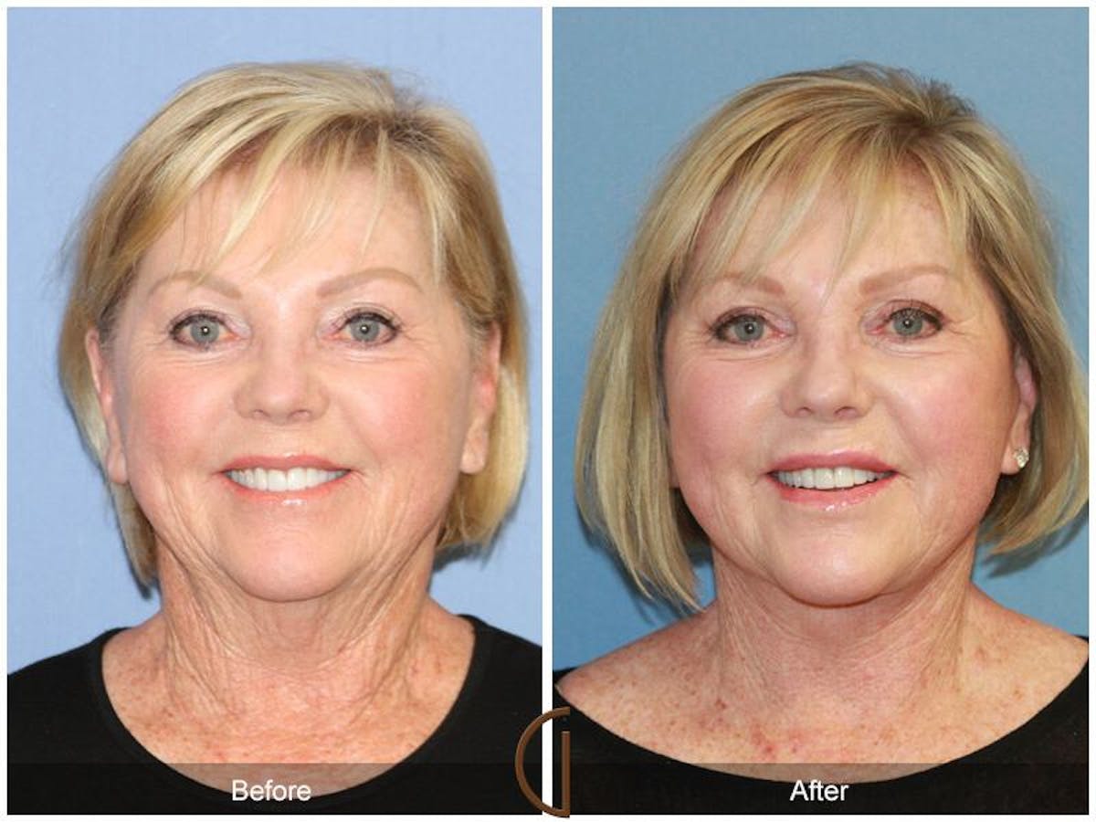 Facelift 60s Before & After Gallery - Patient 134431 - Image 2