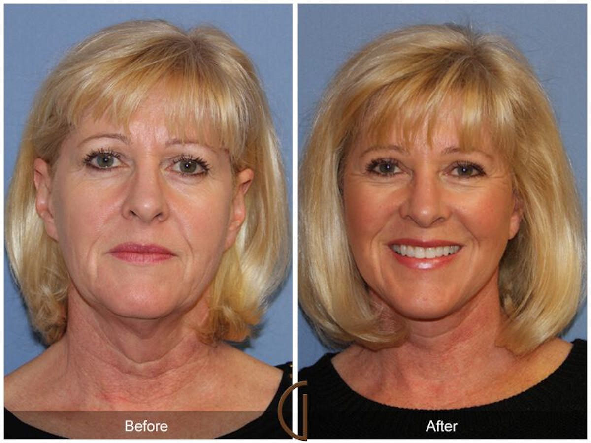 Facelift 60s Before & After Gallery - Patient 146177 - Image 2