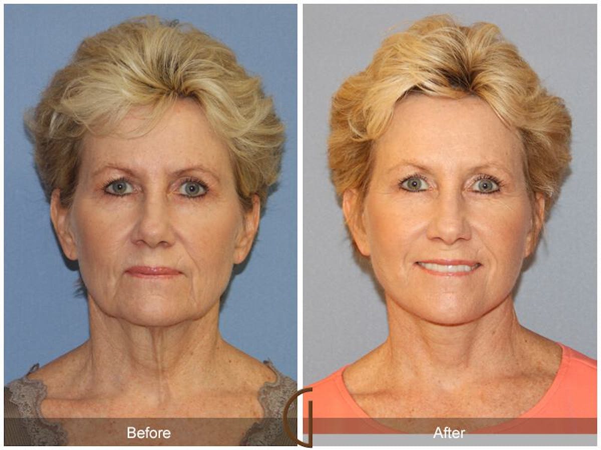 Facelift 60s Before & After Gallery - Patient 140043 - Image 2