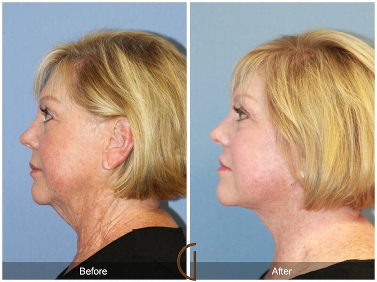 Facelift 60s Before & After Gallery - Patient 134431 - Image 1