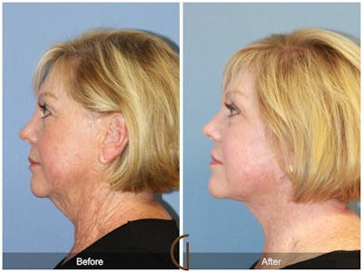 Neck Lift Before & After Gallery - Patient 117240 - Image 1