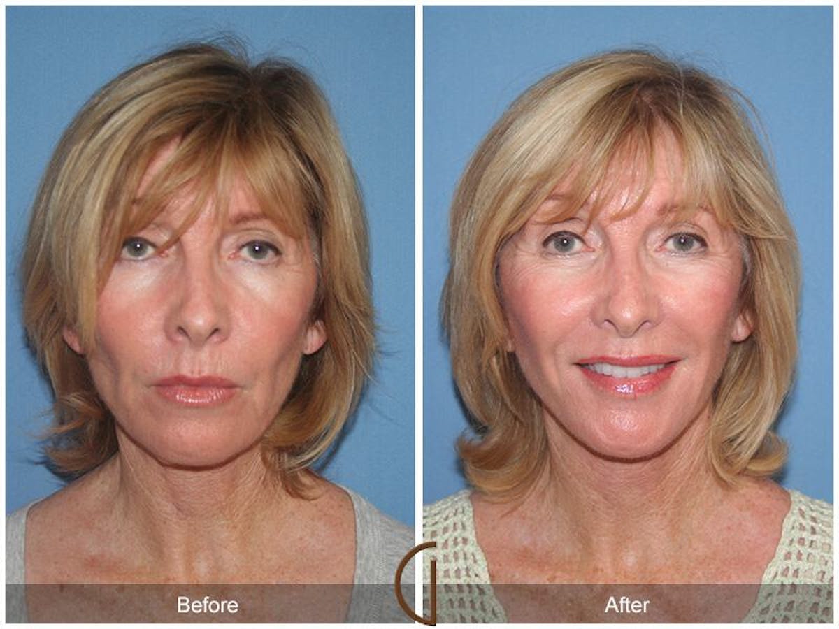 Facelift 50s Before & After Gallery - Patient 354704 - Image 2