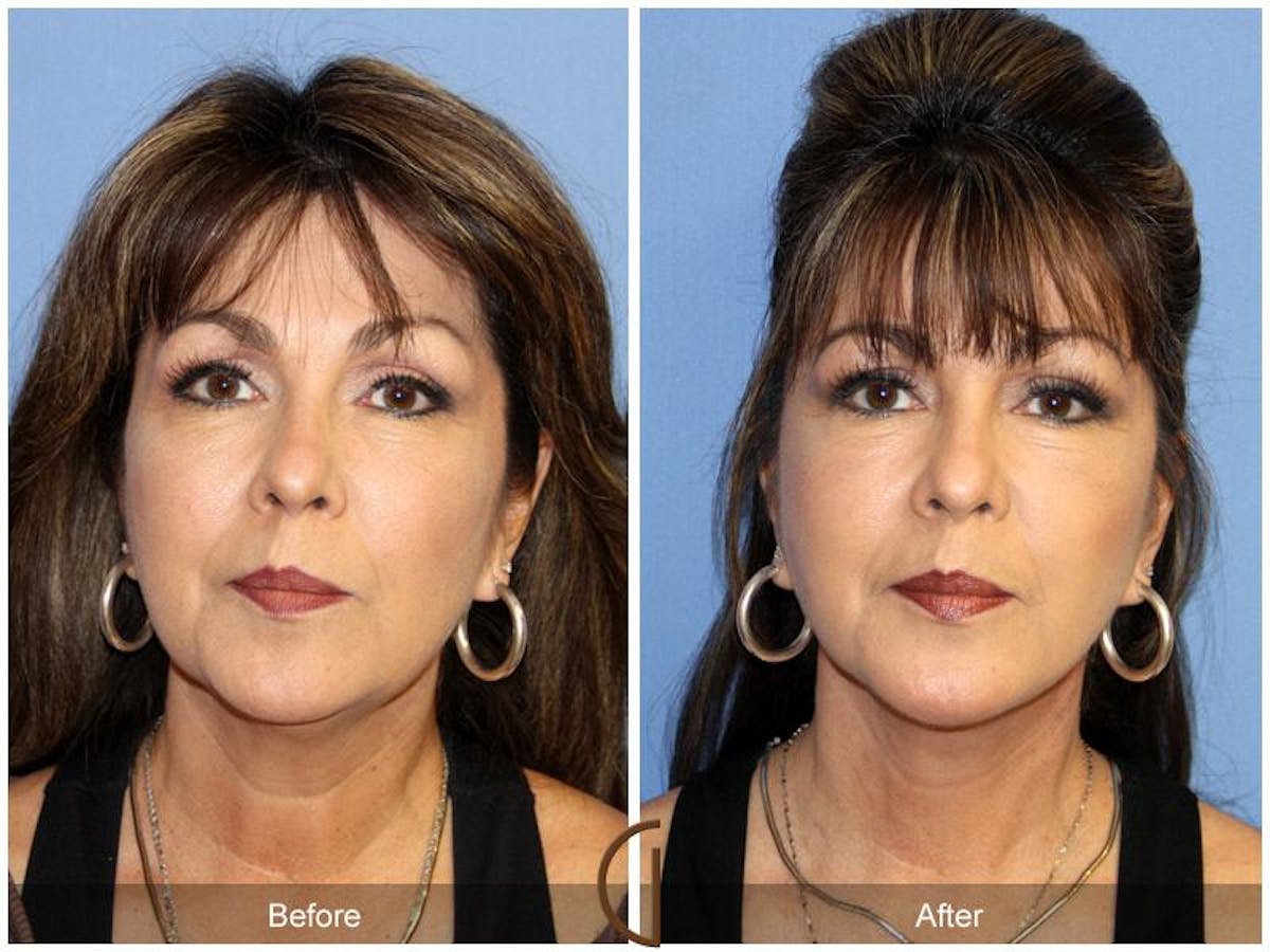 Facelift 50s Before & After Gallery - Patient 170900 - Image 2