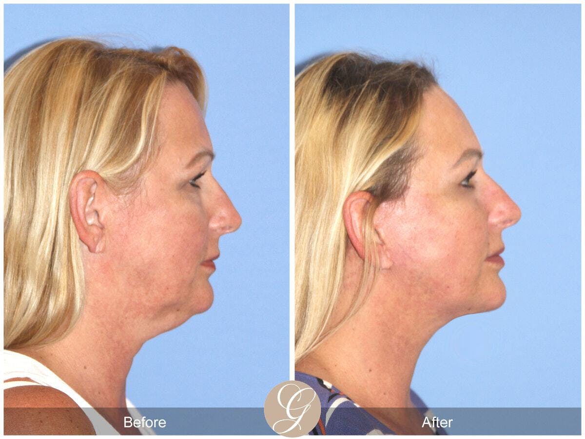 Facelift 50s Before & After Gallery - Patient 258817 - Image 3