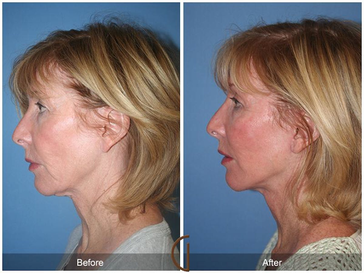 Facelift 50s Before & After Gallery - Patient 354704 - Image 1