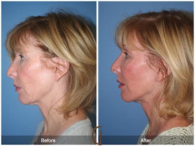 Facelift 50s Before & After Gallery - Patient 354704 - Image 1