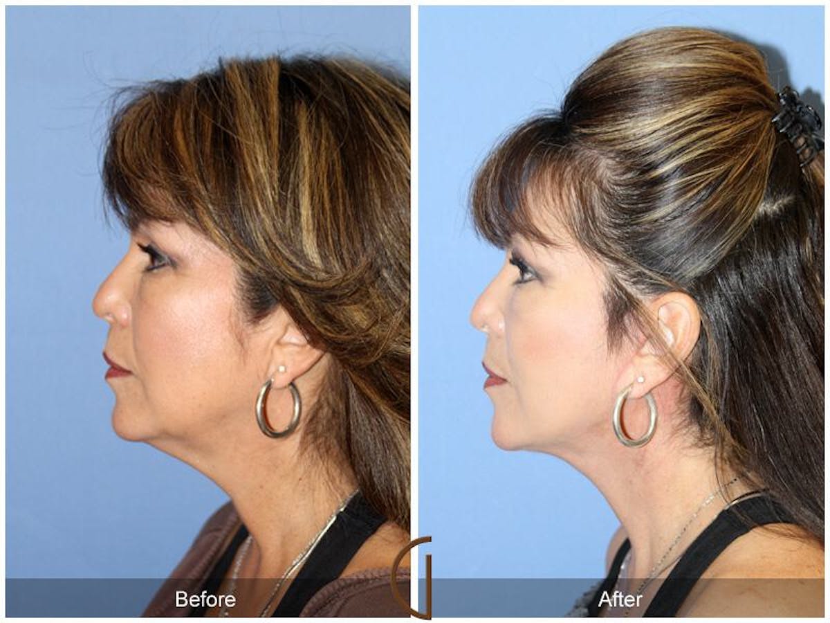 Facelift 50s Before & After Gallery - Patient 170900 - Image 1