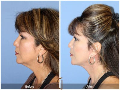 Facelift 50s Before & After Gallery - Patient 170900 - Image 1